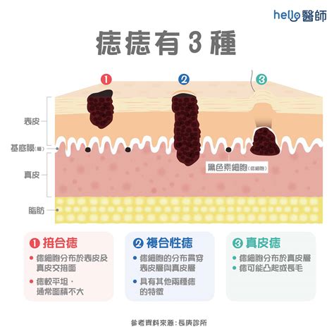 腹部長痣|痣形成的原因？痣長毛、痣變多變大是痣病變？5招判別